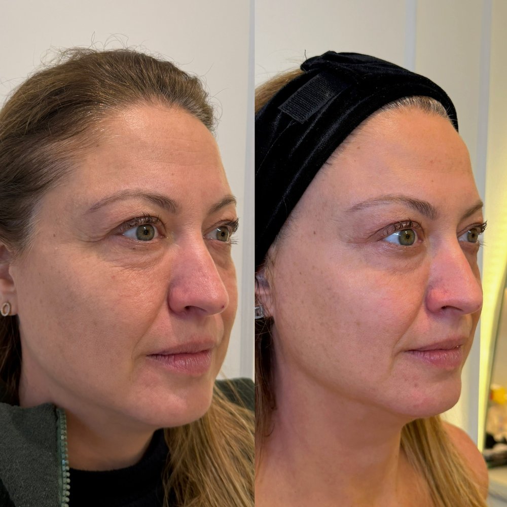 Antes e depois — Perfil: definição do contorno e do terço inferior, com o traço do rosto preservado.